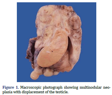 histopathology-multinodular-neoplasia